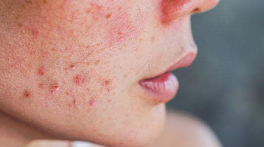 How to Treat Hormonal Acne at Any Age - Antipodes Australia